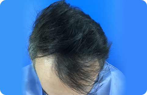antes