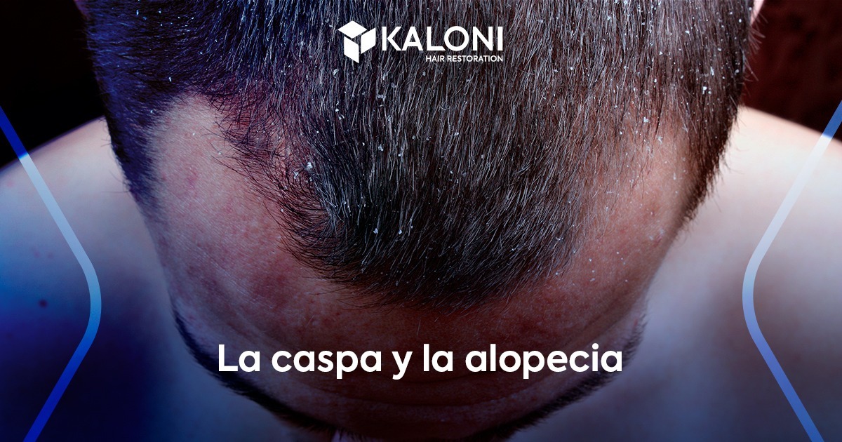 la caspa y la alopecia