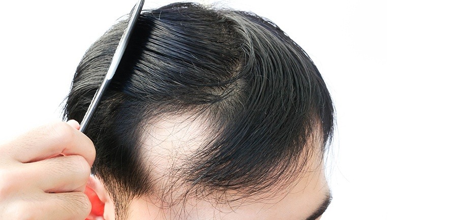 Basta de pretextos para disimular la alopecia 