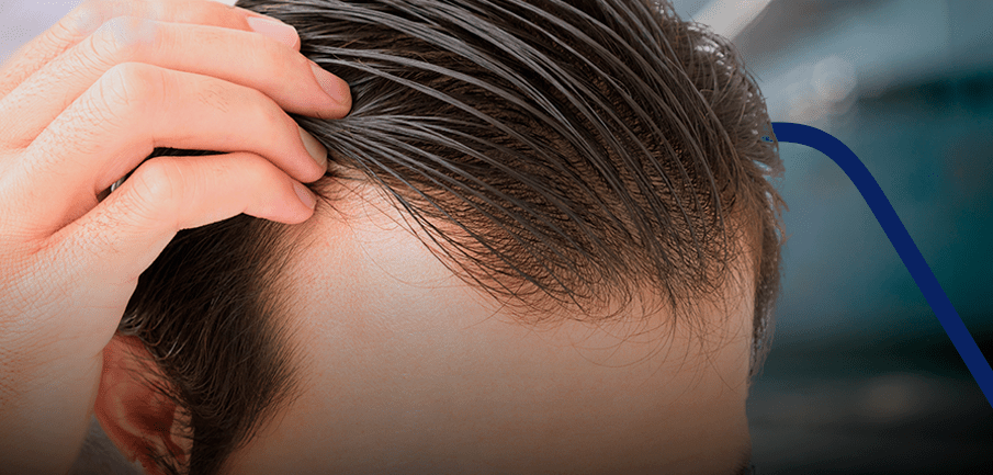 recuperación y evolución del trasplante de cabello largo