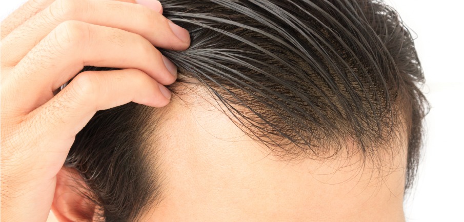 Why does hair fall out? Facts about Hair Loss | Blog Kaloni