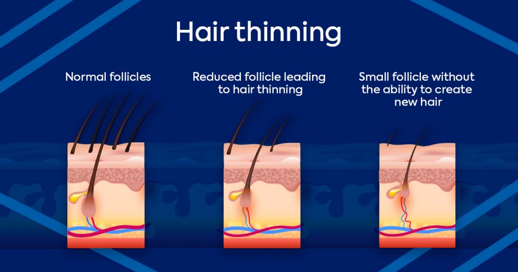 reduced follicle hair thinning