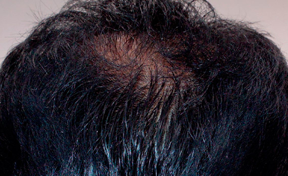 Kaloni Hair Restoration 